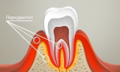 парадонтит